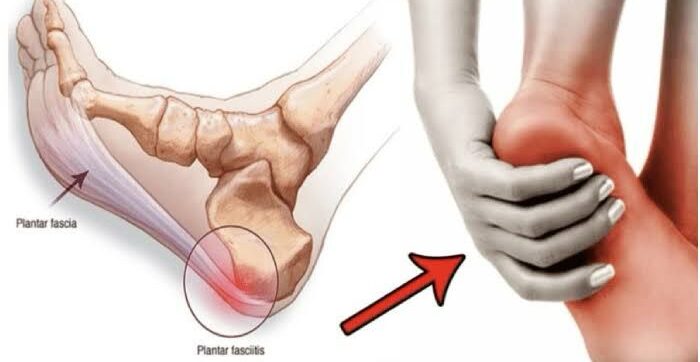 Best calcaneal spur treatment in Gurgaon - MyoHeal Physiotherapy